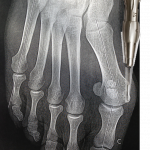 Chirurgie percutanée de l'hallux valgus : fraisage de l'exostose