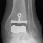 Prothèse de cheville : radiographie postopératoire d'une prothèse de cheville en place